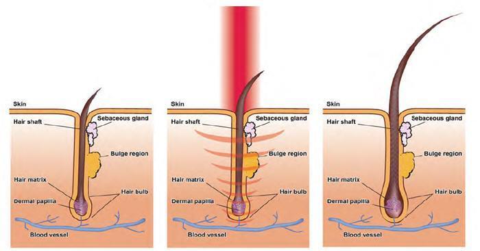 AEXZR® Home Medical Hair Growth Device
